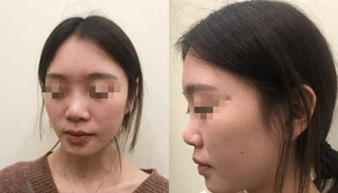 耳軟骨隆鼻術(shù)后三個(gè)月，我有了韓佳人同款美鼻