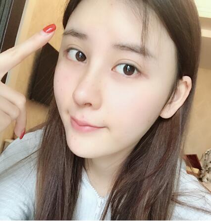 蘭州美月做膨體隆鼻術(shù)后兩個月效果