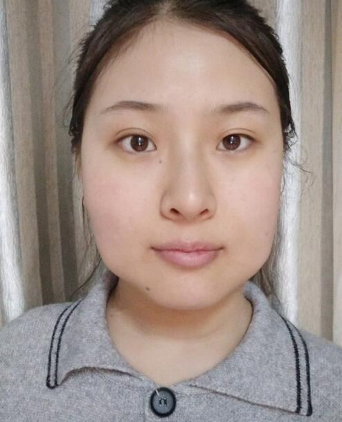 杭州時(shí)光磨骨前后對比，你整成這樣還缺王思聰嗎