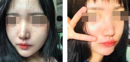 哈爾濱成美整形周小生鼻綜合案例前后對(duì)比圖