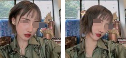 哈爾濱成美整形周小生鼻綜合案例術(shù)后兩個(gè)月