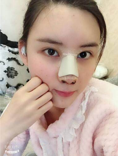 這么好的效果，不來蘭州美月做膨體隆鼻真是白瞎了醫(yī)生的技術