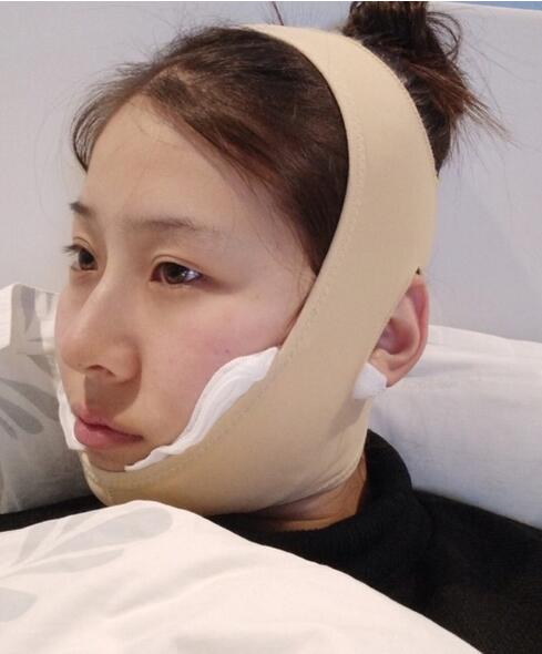 杭州時光磨骨案例術后一周效果