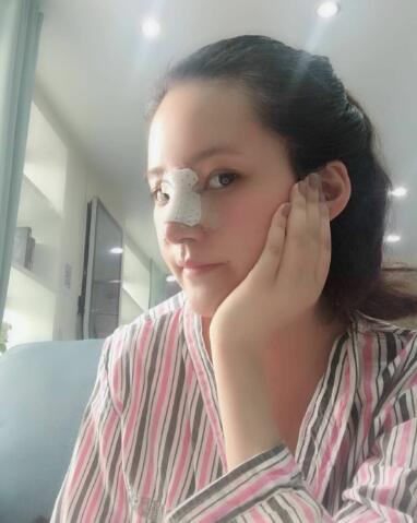 北京葉子整形肋軟骨隆鼻案例手術當天側面
