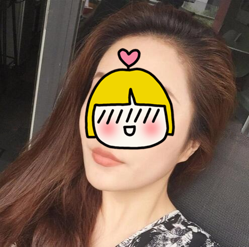 南京藝星整形趙海波面部吸脂一個月效果分享，有圖