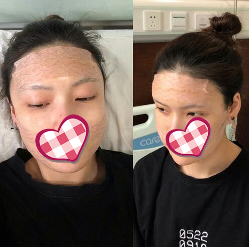 哈爾濱成美自體脂肪全臉填充案例，果然還是飽滿顯年輕