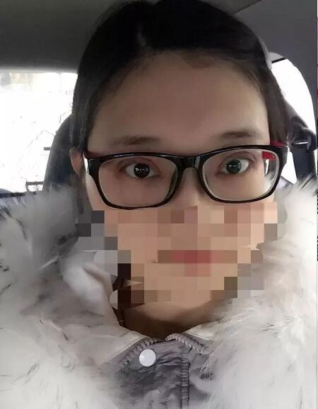 北京京民雙眼皮修復(fù)案例分享，說是媽生眼我都信