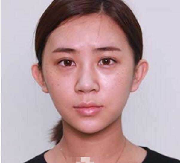深圳鵬程整形劉冰做的鼻子真絕了，跟我想象的一模一樣