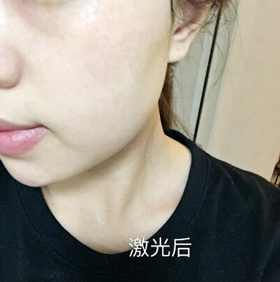 紹興維美整形激光祛斑兩個(gè)療程，皮膚像剝了殼的雞蛋