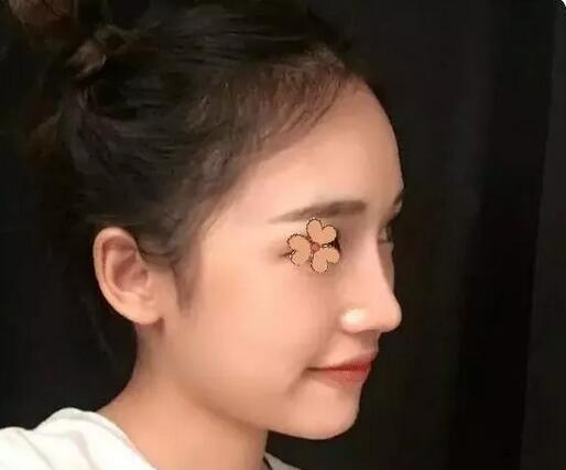 深圳福華整形陳貞宜超體隆鼻術后一個月效果反饋，有圖