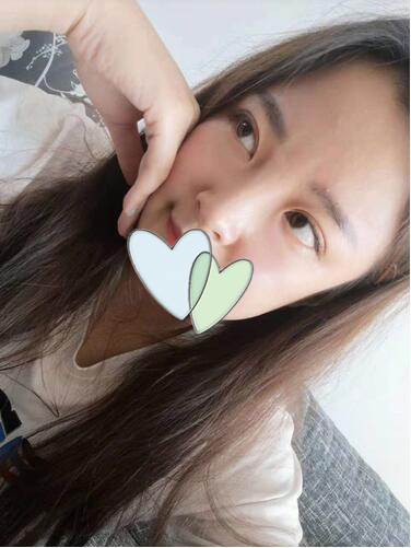 濟南韓式整形雙眼皮術后一個月