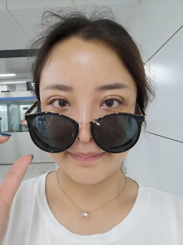 濟南韓式整形雙眼皮術前