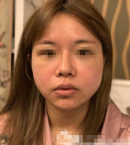 南京閱顏整形瘦臉針案例分享，輕松抗住原相機