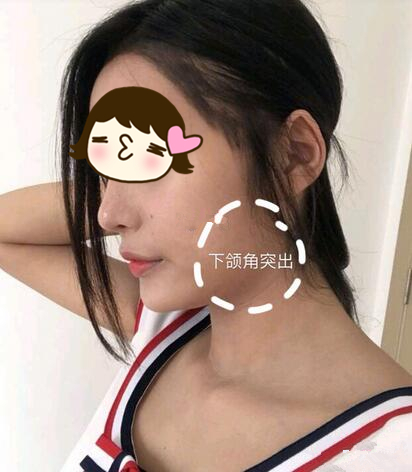 廣州美恩整形下頜角術前