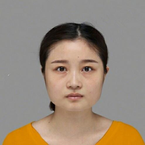重慶美聯(lián)臣下頜角整形術(shù)后三個(gè)月效果反饋，一定要忌嘴