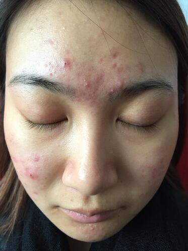 合肥艾雅整形紅藍光祛痘兩個療程效果，痘痘都消失了