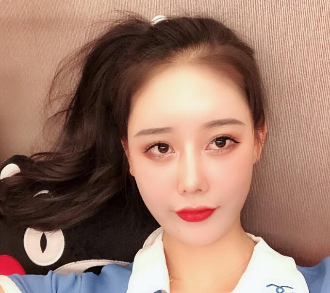 長沙亞韓整形陳明松下頜角整形一個(gè)月效果