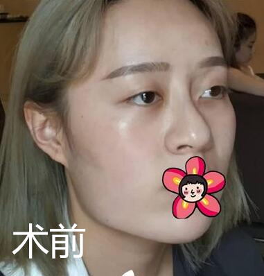 北京基礎(chǔ)美下頜角整形案例效果分享，黃大勇果然名不虛傳