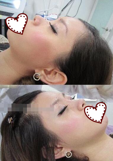 鄭州蘊美整形玻尿酸隆鼻前后對比圖