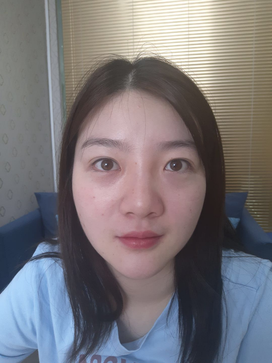 北京圣嘉榮二次鼻修復(fù)案例分享，做整形一定不要去莆田系醫(yī)院