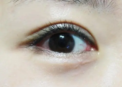 埋線(xiàn)雙眼皮