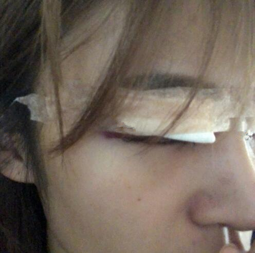 北京崔相平整形雙眼皮修復術后即刻
