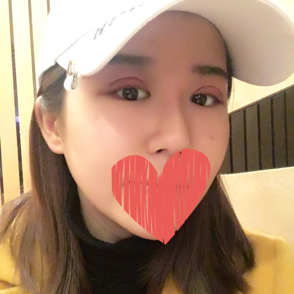 滄州中妤整形張明切開(kāi)雙眼皮拆線后三天效果