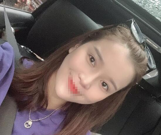 蘭州潤(rùn)妍整形鼻綜合案例分享