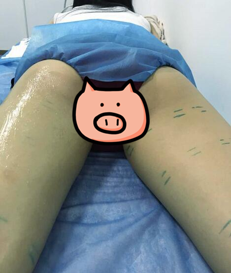 青島大學醫(yī)學院附屬醫(yī)院整形美容燒傷科陳振宇雙腿吸脂術(shù)前