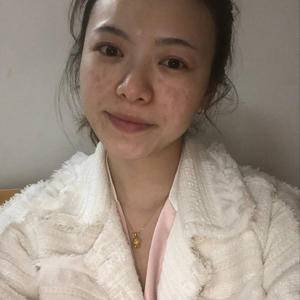 邯鄲佑熙整形孫堅(jiān)激光祛斑前