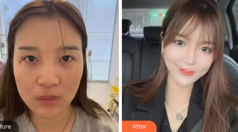 蘭州潤妍整形鼻綜合前后對(duì)比圖