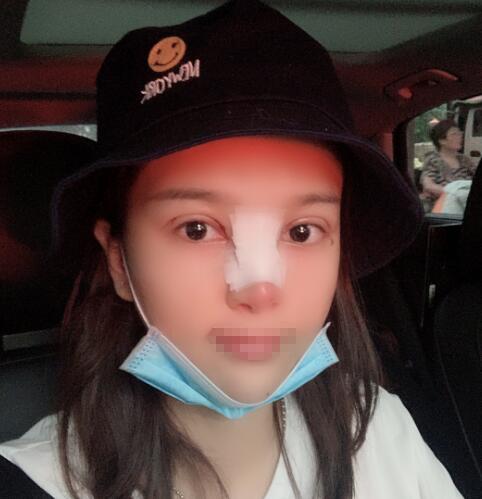 蘭州潤妍整形鼻綜合術(shù)后三天效果