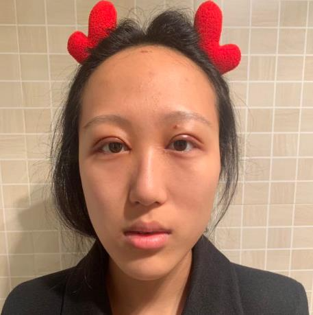 上海華美醫(yī)療美容醫(yī)院楊亞益做眼部修復整形怎么樣？