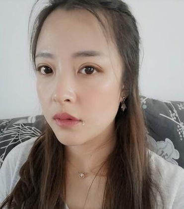 青島伊美爾劉長發(fā)做雙眼皮怎么樣？