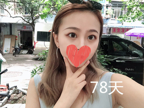 杭州靜港林忠泵埋線雙眼皮案例1-7天效果圖分享，讓你的眼睛魅力四射
