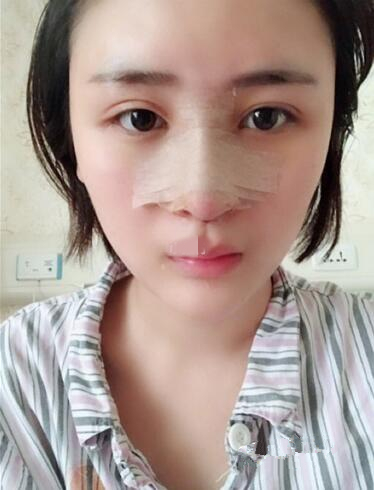 濟南鵬愛整形醫(yī)院怎么樣？濟南鵬愛王飏隆鼻案例分享