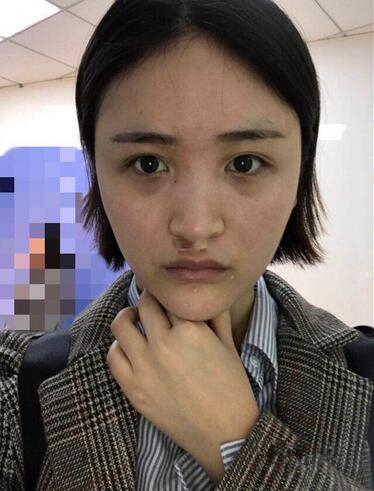 濟南鵬愛整形醫(yī)院怎么樣？濟南鵬愛王飏隆鼻案例分享