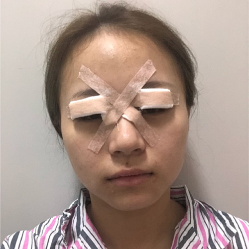 杭州靜港林忠泵埋線雙眼皮案例1-7天效果圖分享，讓你的眼睛魅力四射