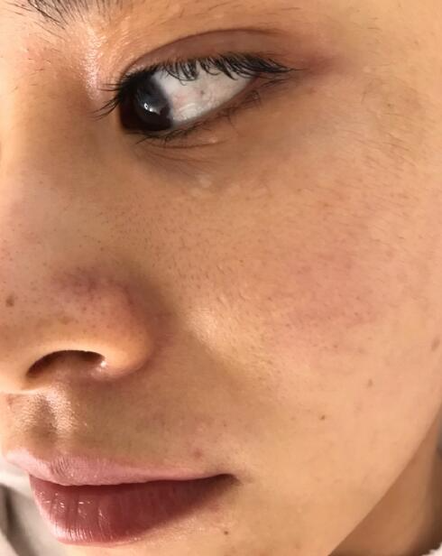 福州愛思特比華利整形林秋蓉醫(yī)生做光子嫩膚過程體驗！皮膚Q彈