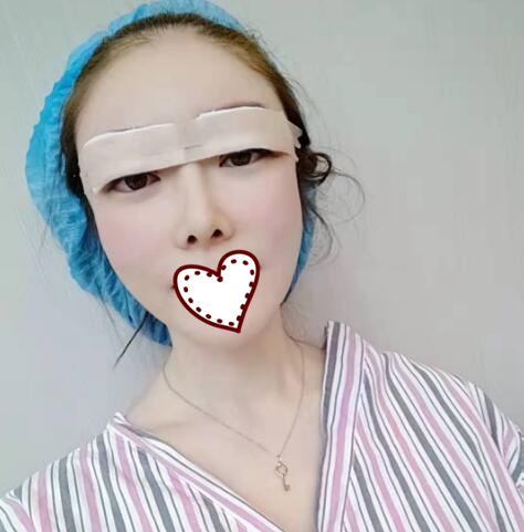 剛做完雙眼皮手術(shù)，還在恢復(fù)過(guò)程中