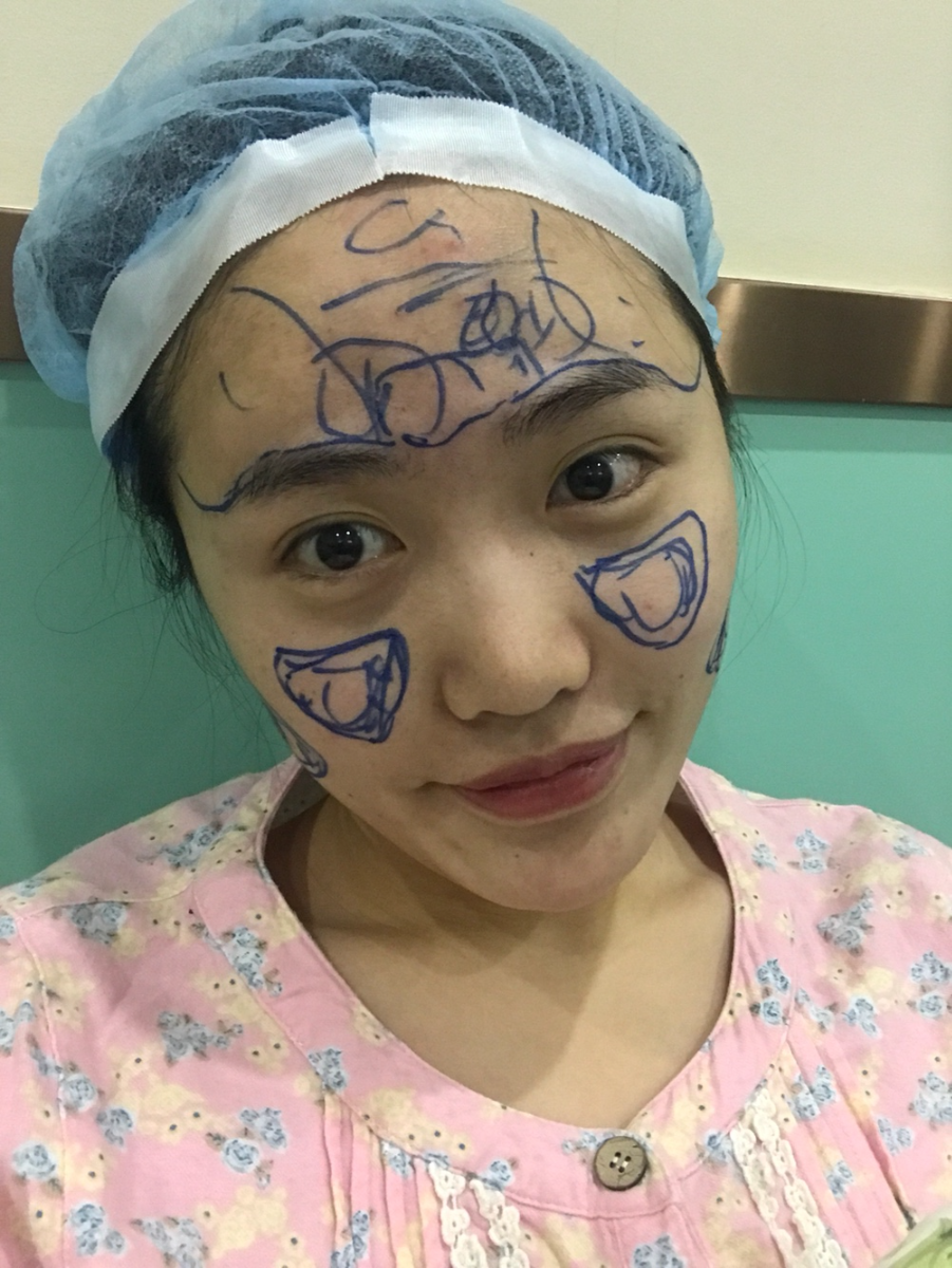 北京星美李寧輝進口膨體隆鼻案例效果對比圖，鼻子自然又美麗