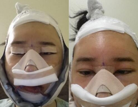 重慶三峽中心醫(yī)院頜面外科張宇下頜角案例手術(shù)效果對(duì)比圖