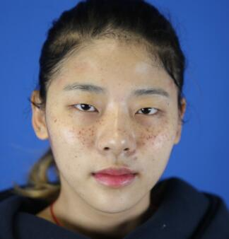 福州愛思特比華利整形林秋榮激光祛斑效果太贊了，終于沒人叫我“斑花”了