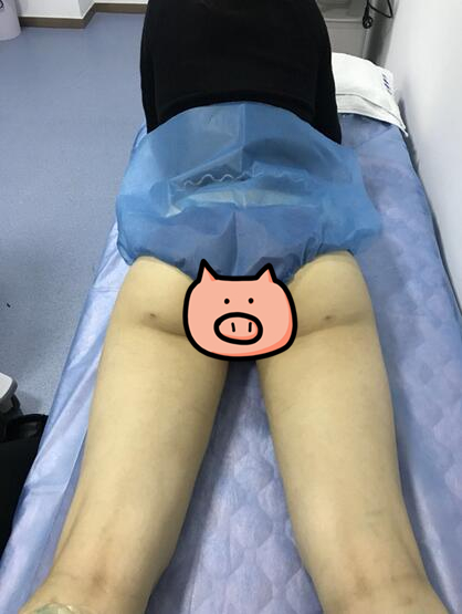 鄭州至美整形專家劉永生做大腿吸脂怎么樣？劉永生做大腿吸脂案例效果