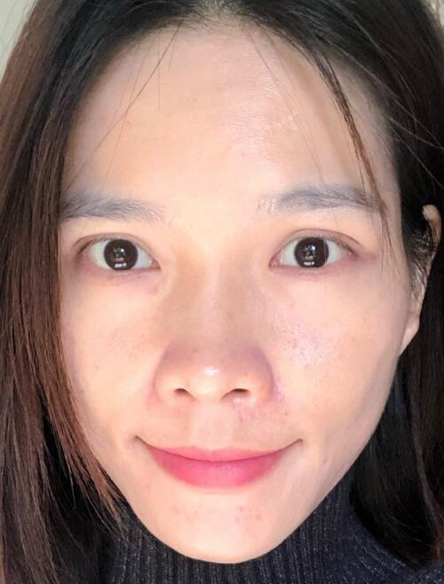 北京藝星整形專家廖苑利做光子嫩膚怎么樣？廖苑利光子嫩膚案例效果展示
