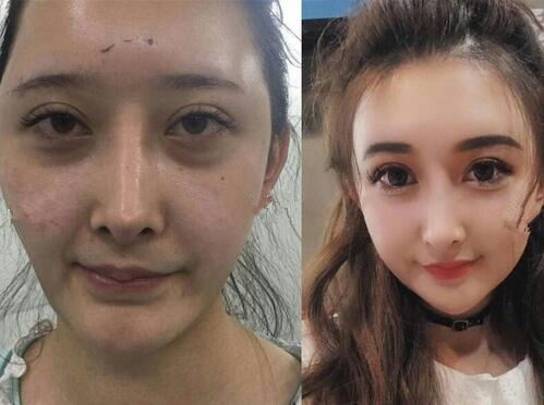 面部脂肪填充，整個(gè)人都發(fā)生了很大變化。