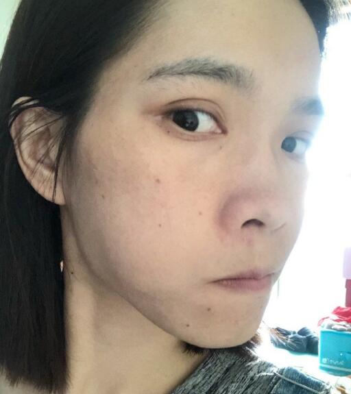 北京藝星整形專家廖苑利做光子嫩膚怎么樣？廖苑利光子嫩膚案例效果展示