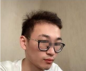 臉上的黑色素沉積使整個人失去光澤