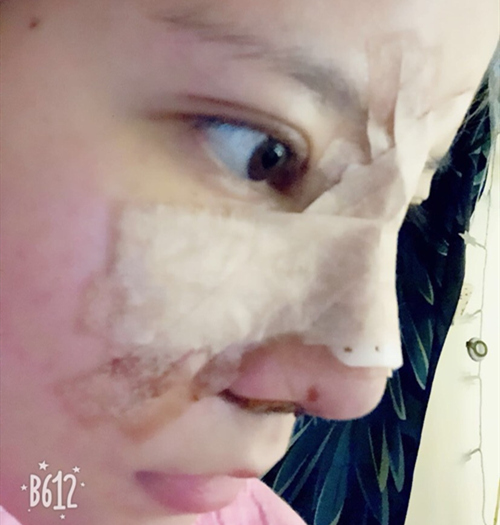 嘉興曙光美容醫(yī)院整形專家王良發(fā)做假體隆鼻怎么樣？王良發(fā)假體隆鼻案例