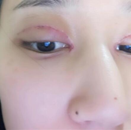 北京葉子整形美容醫(yī)院做焊接雙眼皮效果怎么樣？北京葉子整形焊接雙眼皮案例展示